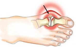 Воспаление сустава между большим пальцем и стопой при артрите